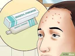 Why do i have acne in my forehead? 4 Ways To Get Rid Of Forehead Acne Wikihow