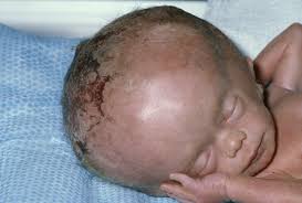 Hydrozephalus Gesundheitsprobleme Von Kindern Msd Manual Ausgabe Fur Patienten