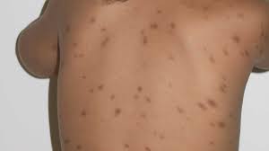 Image result for Urticaria pigmentosa children