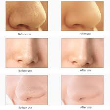 Derma Suction Siyah Nokta Cikarma Aleti Tutyakala Com En Ilginc Hediyeler Siyah Noktalar Cil Nokta