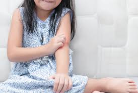 5 Cara Mengatasi Alergi Kulit pada Anak