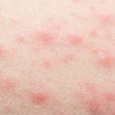 Image result for contact dermatitis