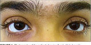 Image result for Mydriasis