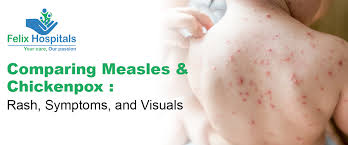 Image result for measles