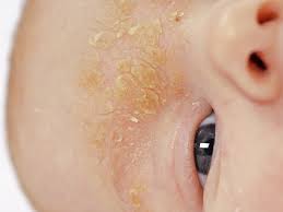 Does your baby have dry scalp? What You Need To Know To Recognize Treat And Cope With Cradle Cap Babycenter