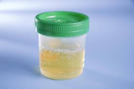 Kenali penyebabn dan cara mengatasi kondisi ini. Air Kencing Berbuih Foamy Urine Ceriasihat