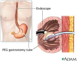 Gastrostomy Tube Placement Series Procedure Part 2 Medlineplus Medical Encyclopedia