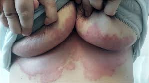 Intertrigo (intertriginous dermatitis) is an inflammatory condition of skin folds, induced or aggravated by heat, moisture, maceration, friction. Candida Intertrigo On The Infra Mammary Folds Of A Middle Aged Woman Download Scientific Diagram