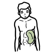 Image result for Splenomegaly