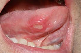 Image result for mouth ulcer on tongue)