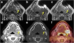 Surgery can be as simple as using laser therapy to remove cancerous tissue, to more aggressive surgical approaches in case of large. Cross Sectional Imaging In Cancers Of The Head And Neck How We Review And Report Cancer Imaging Full Text