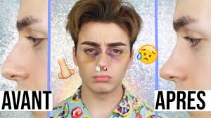 MA RHINOPLASTIE 👃🏻| JE VOUS DIS TOUTE LA VÉRITÉ 🤷🏼‍♀️