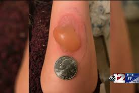 A rash can surround the bite and potentially spread to the rest of the body. Brown Recluse Spider Bite Brown Recluse Spider Bite