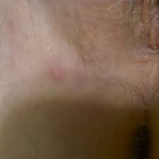 That's why early detection is so critical to your. Herpes Pictures