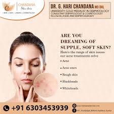 Acne treatment does not only clear pimples. here, at chandana skin clinic,  our holistic acne treatments solve a range of skin issues. 𝑭𝒐𝒓 𝒎𝒐𝒓𝒆  𝒊𝒏𝒇𝒐𝒓𝒎𝒂𝒕𝒊𝒐𝒏, 𝒑𝒍𝒆𝒂𝒔𝒆 𝒗𝒊𝒔𝒊𝒕 𝒐𝒖𝒓 𝒘𝒆𝒃𝒔𝒊𝒕𝒆
