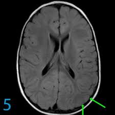 A typical scan of a human's brain will reveal many complicated wrinkles, folds, and. Why Is This 2 Year Old Behind In Development Proscan Imaging