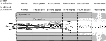 The study included 110 patients diagnosed with ulnar nerve injury (sunderland grade 5). Classification Of Nerve Injuries Springerlink
