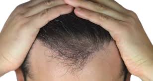 Il costo medio di un trapianto di capelli senza rasatura in turchia, in istanbul è di 1450 €. Tricopigmentazione E Trapianto Di Capelli Stefano Rogora