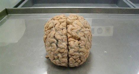 The Brains of People With Walking Corpse Syndrome Might Actually Be  Shutting Down