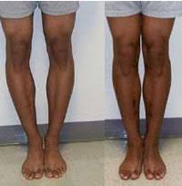 I try to hide my gait as much as possible when i walk, and i feel really uncomfortable. Realignment Of Bowleg And Knock Knee Deformities