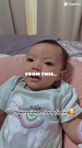 hemangiomababy