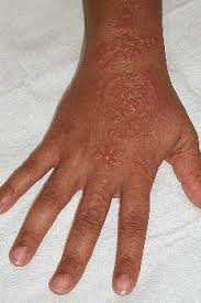 Once sensitized, the patients may experience allergic contact dermatitis from the use of hair dyes containing ppd. Temporary Tattoos Reactions To Black Henna Tatoos In Bali Health And Medical Concerns In Indonesia