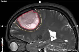 Astrozytom Und Oligodendrogliom Neurochirurgie Inselspital