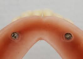 Le tracé du crochet doit toujours se situer sous la bonjour docteur je suis édentée totale sauf une dent du bas (molaire) qui ne m'avait pas été enlevée par mon dentiste après être passée par une. Comment Faire Tenir Un Dentier Du Bas Un Appareil Inferieur