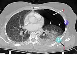 There are several different ways to classify and name pneumothoraces. Figure Ct Rib Fracture Ct Scan Pneumothorax Collapsed Lung Contributed By Steve Bhimji Ms Md Phd Statpearls Ncbi Bookshelf
