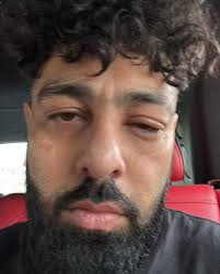 rapper badshah Suffers eyes