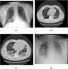 A pneumothorax occurs when air leaks into the space between your lung and chest wall. Pneumothorax And Pneumomediastinum In Covid 19 A Case Series The American Journal Of The Medical Sciences