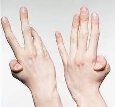 A child with hypermobile joints may lose the ability to hyperextend as they age. Double Jointed Or Hypermobile Oh My Arthritis