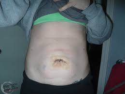 Adventures With Umbilical Hernia Surgery The First 72 Hours Relentless Forward Commotion
