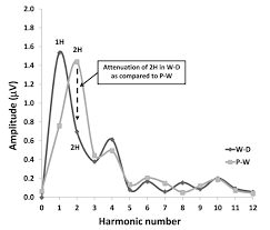 In a migraineur's brain, the sensory neurons have much. Lateral Inhibition In Visual Cortex Of Migraine Patients Between Attacks The Journal Of Headache And Pain Full Text