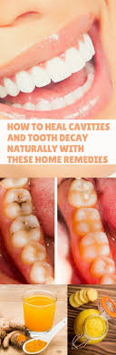 Root fillings, tooth crowns, composite but it's not just what you eat — it's how you eat it. How To Heal Cavities And Tooth Decay Naturally With These Home Remedies Heal Cavities Tooth Decay Cavities