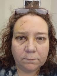 Severe Brain Injury and Recovery Story