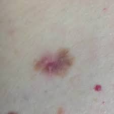 Knowing what it looks like can help you get the treatment you need. Melanoma Pictures Example Pictures Of Melanoma Symptoms
