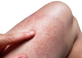 Image result for allergy rash on the legs