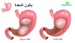 تجربتي مع بالون المعدة التجارب والآراء تجميلي