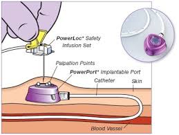 Central Lines Port A Cath Port Iv Therapy Patient Care