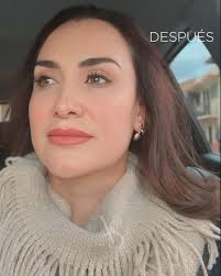 𝐓𝐃𝐋 𝐋𝐈𝐅𝐓 + subfacial 𝐓𝐄𝐂𝐇 , 𝑏𝑦 𝑁𝑜𝑟𝑎 𝑆𝑡𝑎𝑛𝑓𝑜𝑟𝑑 ,  𝐺𝑟𝑎𝑐𝑖𝑎𝑠 𝑎 𝑚𝑖 ℎ𝑒𝑟𝑚𝑜𝑠𝑎 𝑝𝑎𝑐𝑖𝑒𝑛𝑡𝑒 ꨄ, Tunneled deep lift  ideal para pacientes jóvenes o en envejecimiento con buen volumen de tercio  medio facial., Enfocado ...