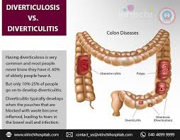 Diverticulosis Vs Diverticulitis Diverticulitis