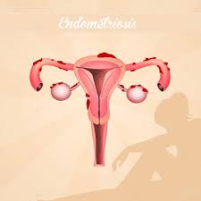 There are different ways to measure endometriosis. Stockfotos Endometriose Bilder Stockfotografie Endometriose Lizenzfreie Fotos Depositphotos