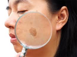 Nov 22, 2017 · all you have to get rid of the brown patches is to dab a cotton ball soaked in milk to the affected areas of the face at night. 5 Different Types Of Skin Blemishes On The Face And Its Treatments Skinkraft