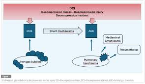 Image result for Decompression Sickness