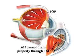Image result for Intraocular Pressure