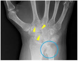 Image result for XRay Changes in Rheumatic Conditions