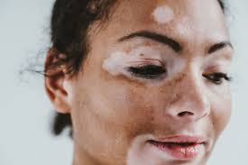 Image result for Vitiligo