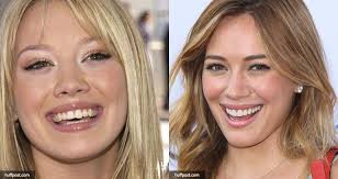21 Celebrities With Dental Implants Or Cosmetic Dentistry Cosmetic Dentistry Celebrity Teeth Discolored Teeth