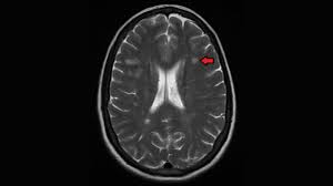 Image result for Brain Lesion